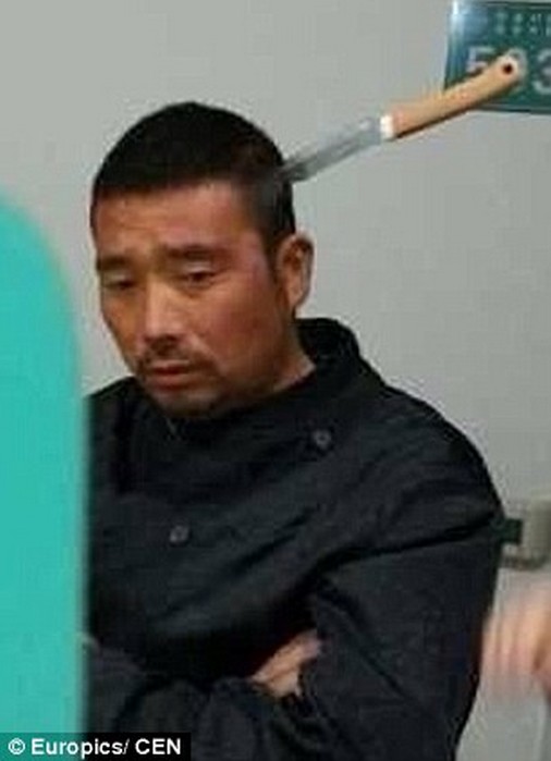 Китаец самостоятельно пришел к врачу с ножом в голове
