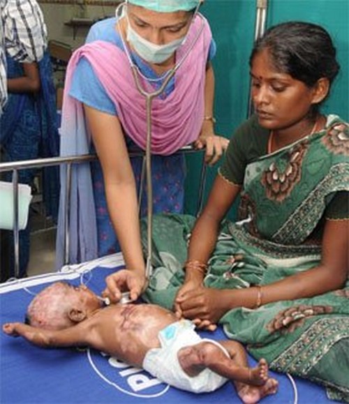 Индийский ребёнок, из обычной деревни периодически спонтанно самовозгорается
